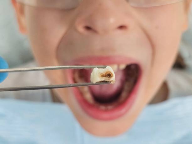 Best Emergency Wisdom Tooth Extraction in Lake Sconsin, WI